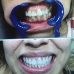 Before and after images