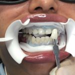 Patient receiving teeth whitening services