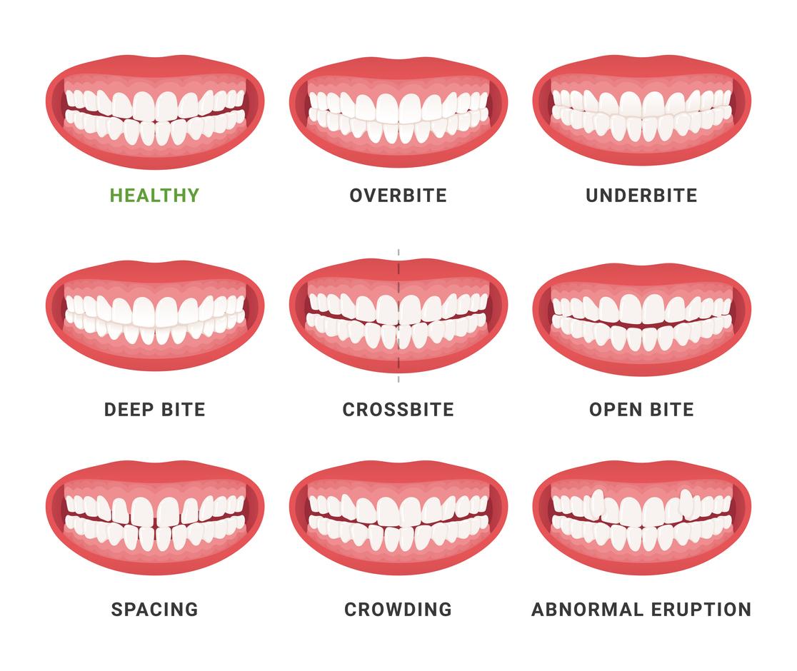 Custom Invisalign Treatment Plans