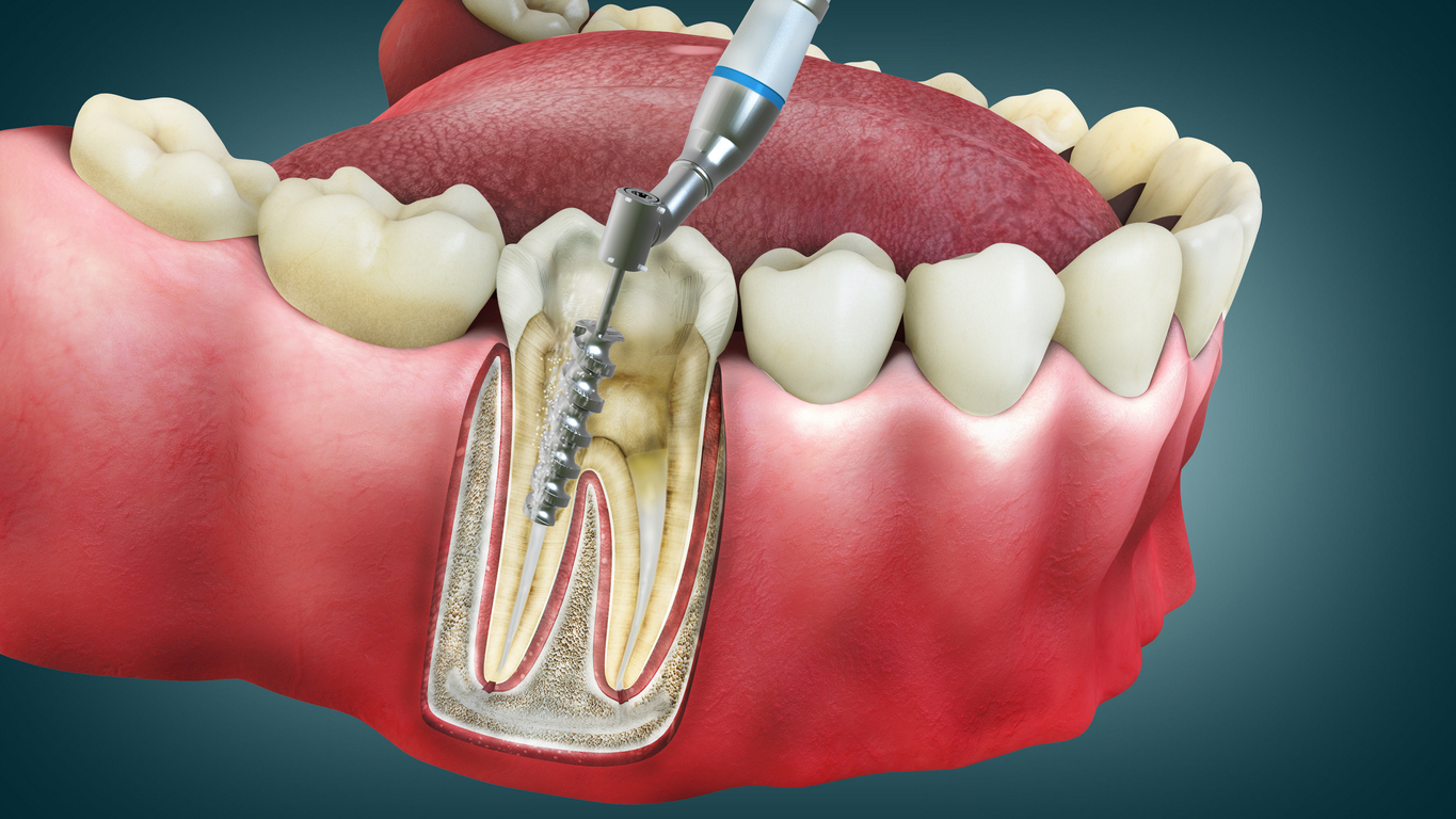 Root Canal Process