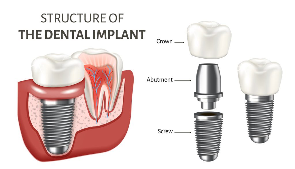 Strucutre of The Dental Implants