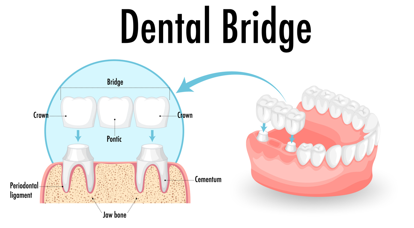 Infographic showing a dental bridge going into the right side of the lower arch of teeth.