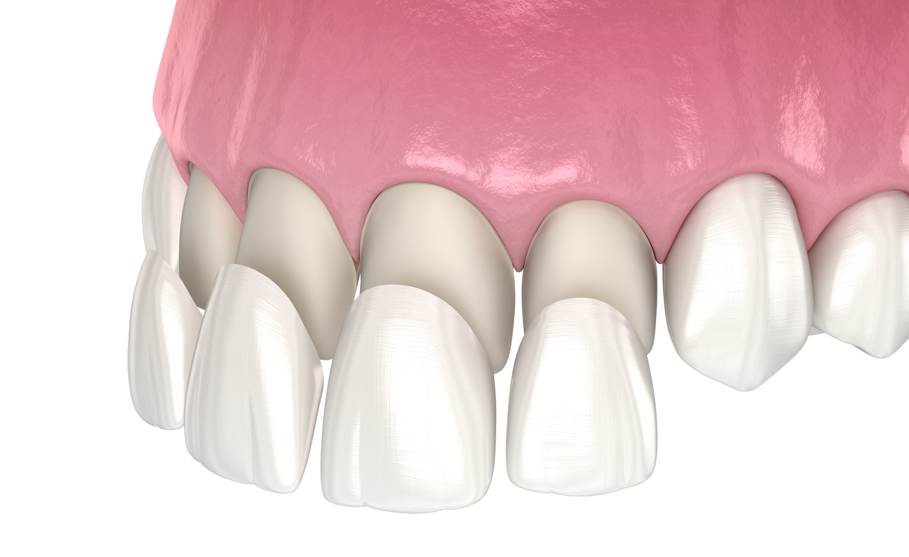 Dental veneers being placed over discolored upper front teeth.