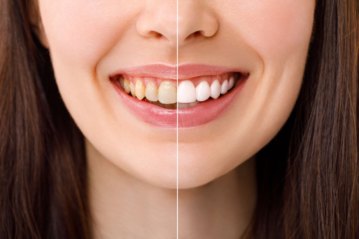 Before and after of the tooth whitening process